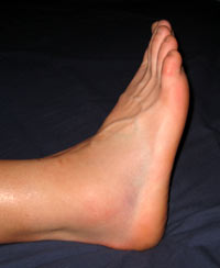 My sprained ankle - day 2