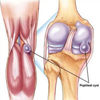 Baker's cyst (Popliteal cyst)